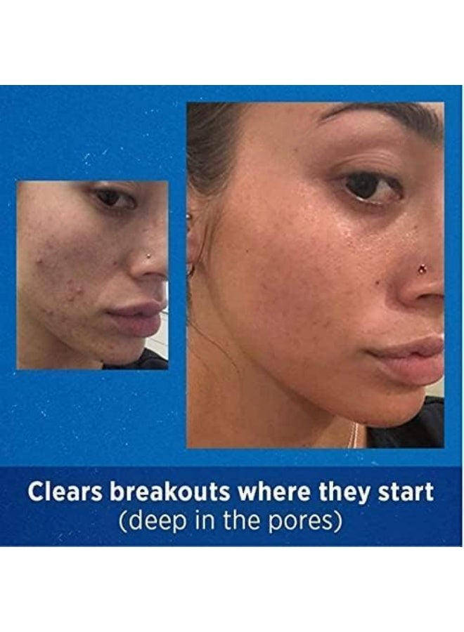 ديفرين جل أدابالين 0.1% لعلاج حب الشباب وتقشير الوجه - عبوة توفير (قطعتين × 30 غرام) - تركيبة ريتينويد لتجديد البشرة - Image 3